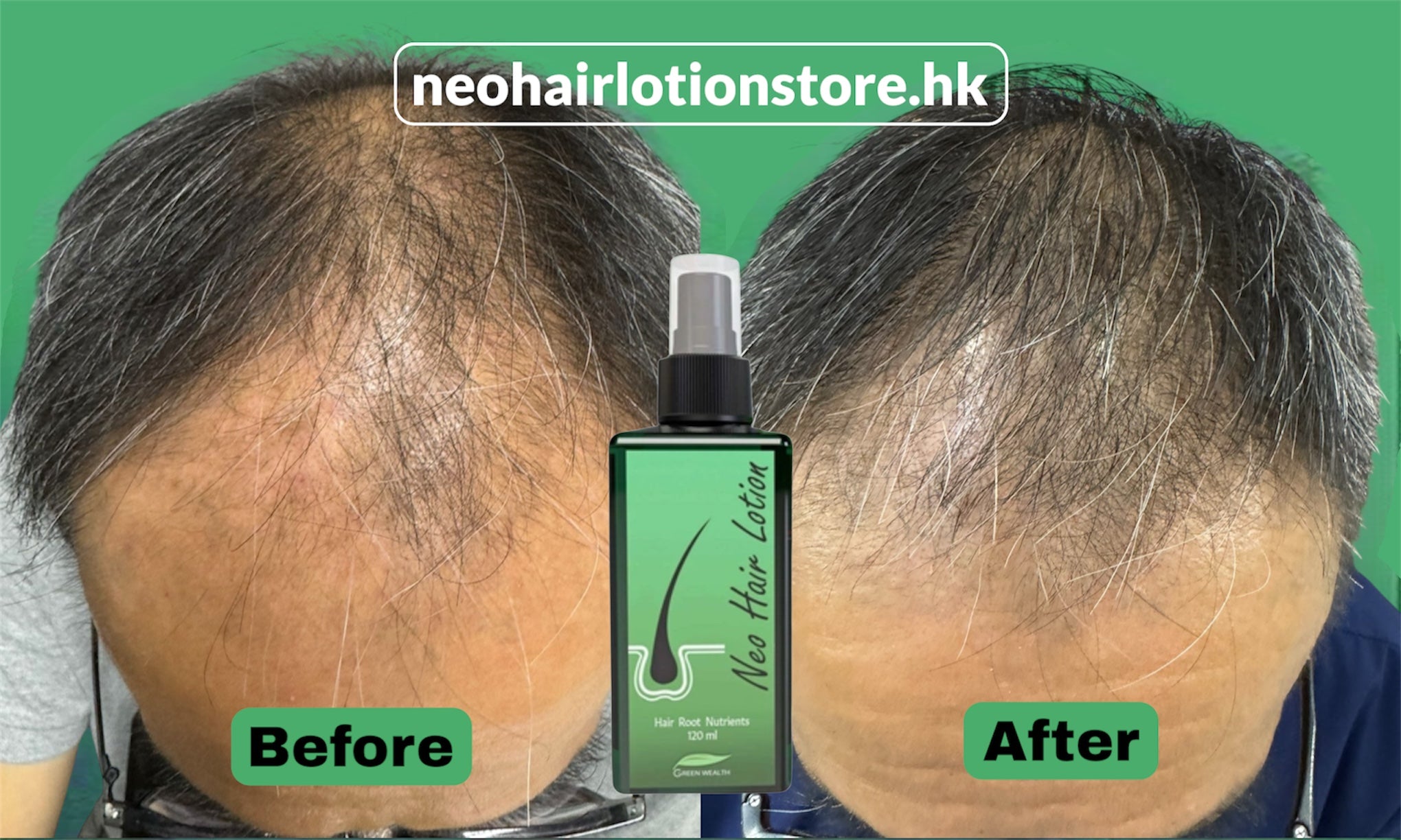 Before and after comparison of hair treatment with a bottle labeled 'Neo Hair Lotion' on a green background.