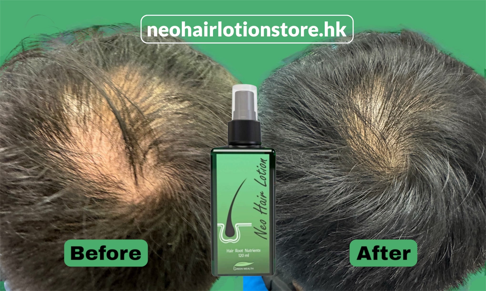 Before and after comparison of hair growth with Neohairlotionstore.hk product on a green background.